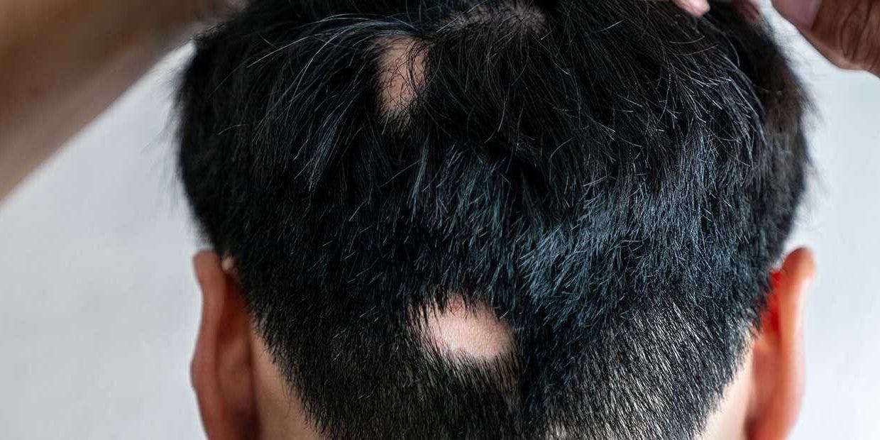 Cover Image for Alopecia: o que é, principais causas, tipos e tratamentos