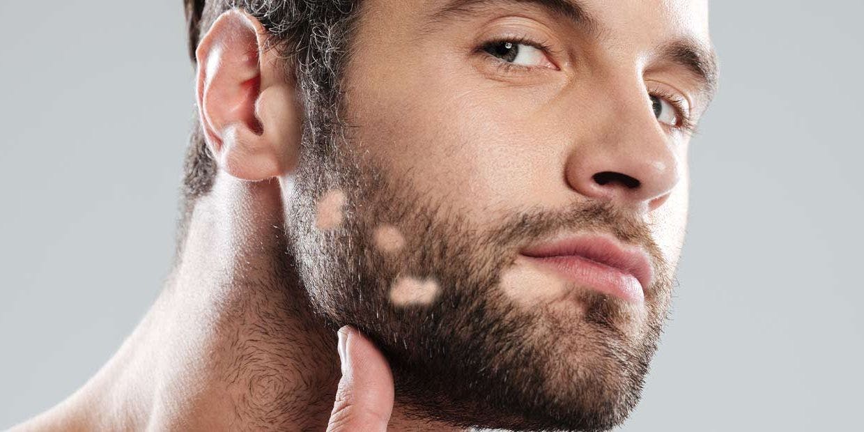 Cover Image for Falhas na barba: descubra as causas e saiba como resolver o seu problema!