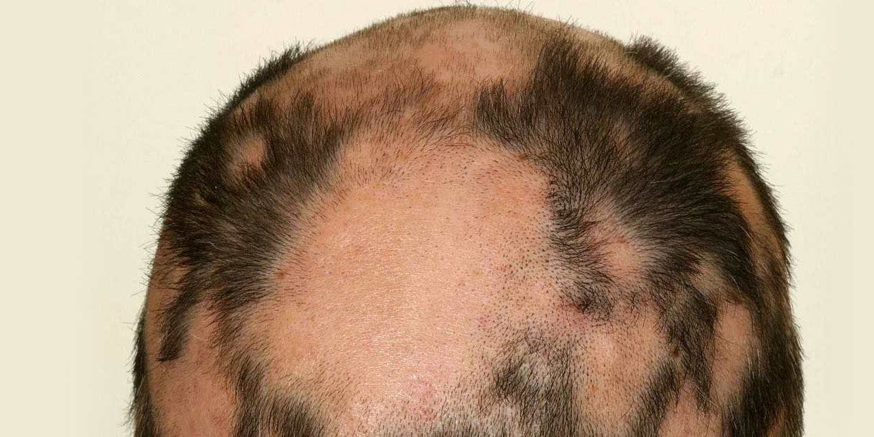 Cover Image for Descubra as opções de tratamento para alopecia areata — trate a queda de cabelo de forma eficaz